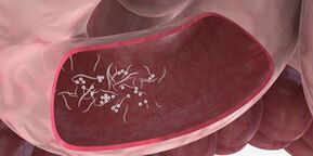 El uso de trillizos para eliminar los parásitos