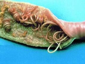 Las causas de los parásitos en el cuerpo humano